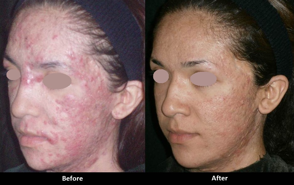 Chemical Peels - A E Skin - Med Spa Encino, CA