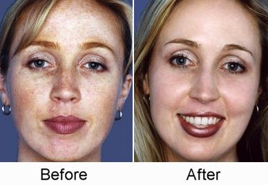 before and after chemical peel
