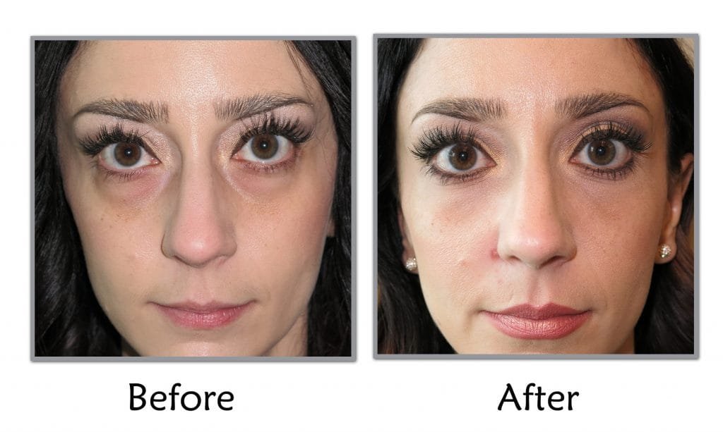 Tear-trouph-before-and-after-e1406827503609