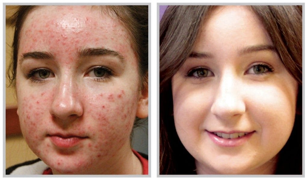 Things-to-consider-before-opting-for-Laser-Skin-Resurfacing