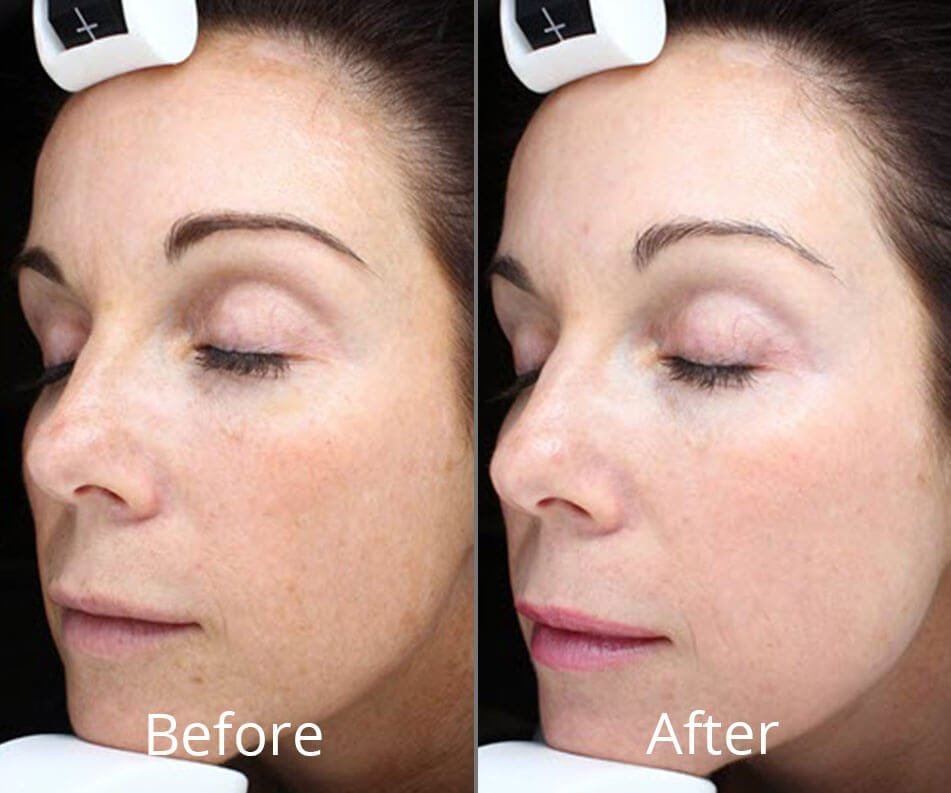 before-after-halo-fractional-laser-morgantown-west-virginia-willow-medspa-full-1
