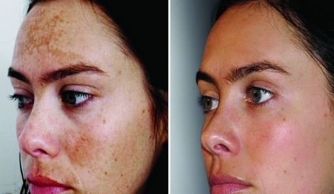 before-and-after-chemical-peel[1]
