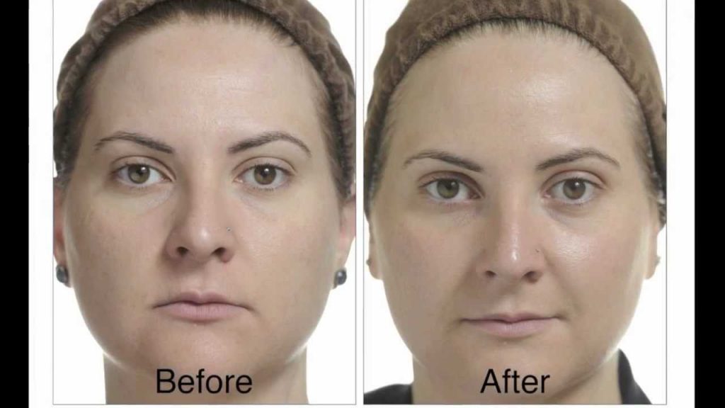 What happens after a chemical peel