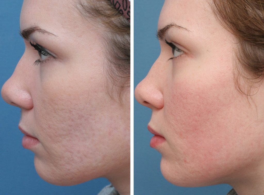 acne-scars-before-after-2