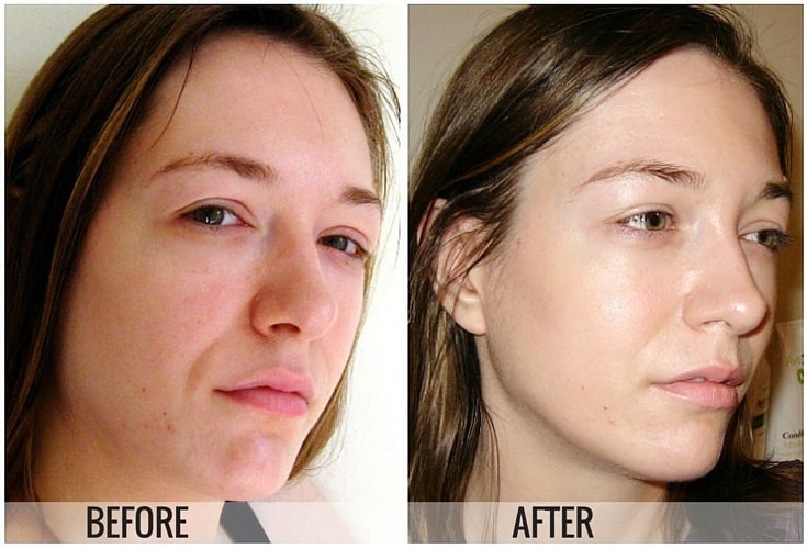 chemical peel before and after 2