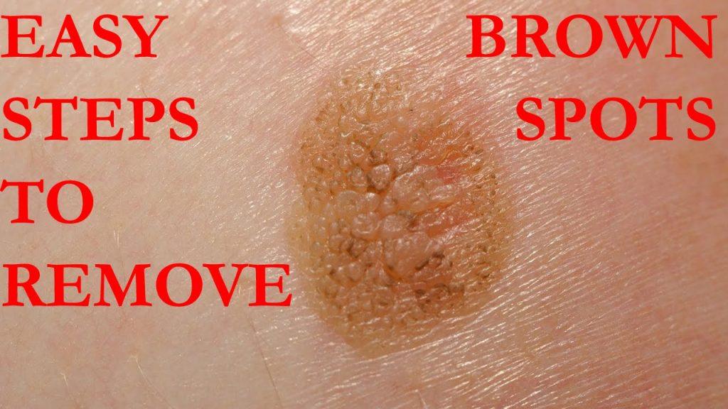 brown spots on skin